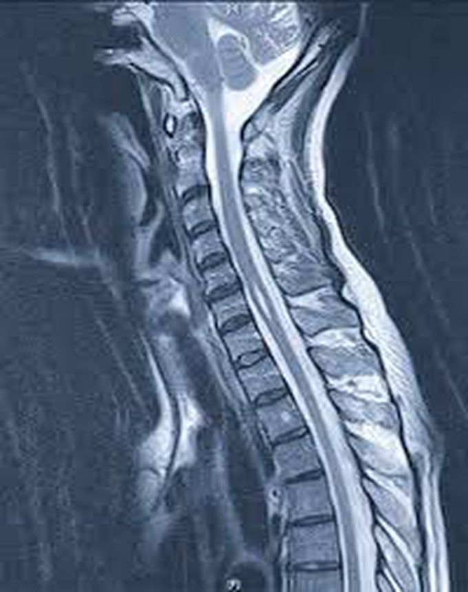 Treatment for syringomyelia