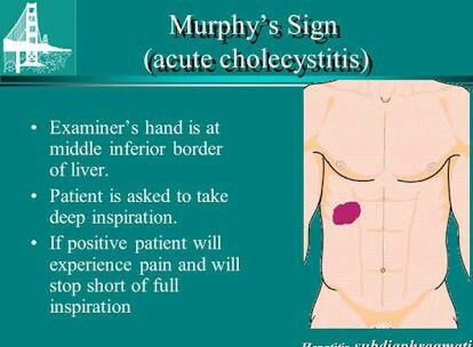 Sign of cholecystitis