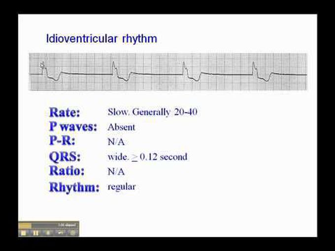 Idioventricular Rhythm: ECG explained