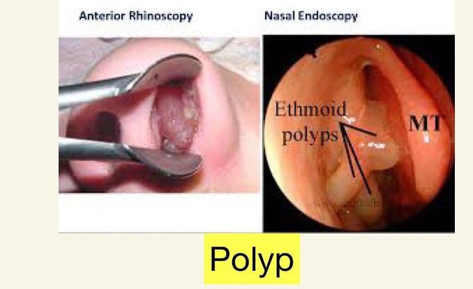 Polyp