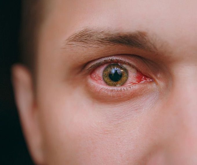 Case female pt : history of diabetes has the following problems in eye: anisocoria (asymmetrical pupil) sometimes ,,headache ,, heaviness& redness& dilated of arteries of sclera left eye,, what is the diagnosis? 👁