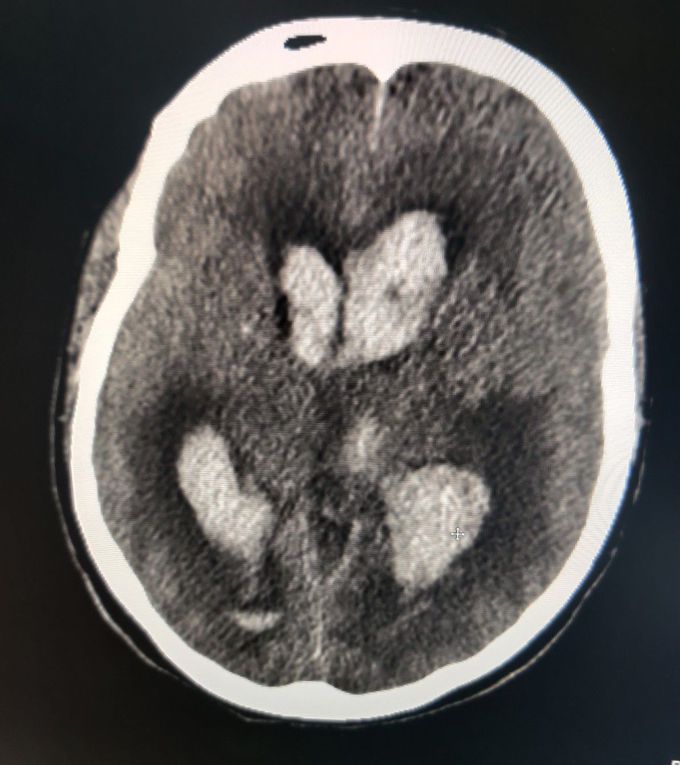 B/L Hemorrhagic CVA including lateral ventricles and 3rd Ventricle