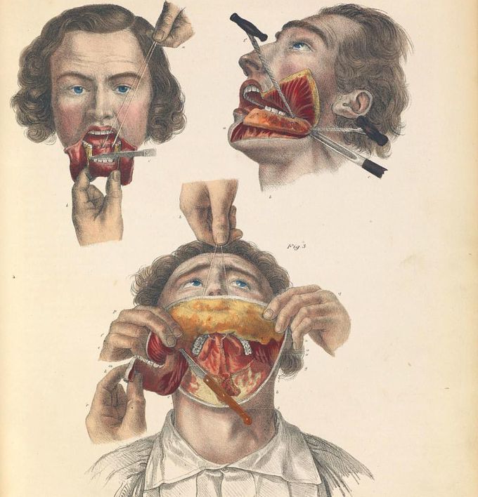 Here is an illustration demonstrating total removal of the lower jaw due to a malignant tumor from 1841