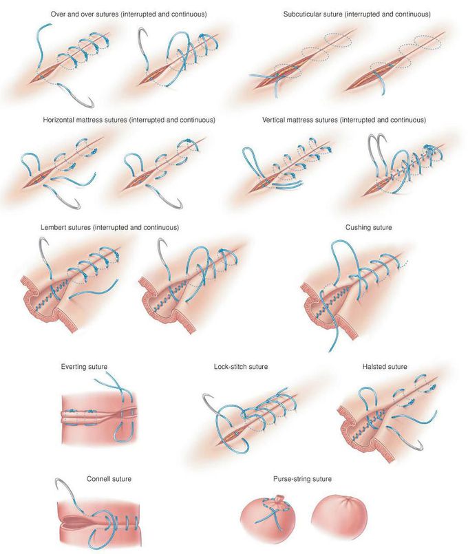 Types of surgical suture...