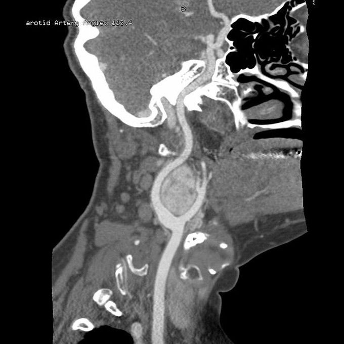 Carotid Body Tumour!  