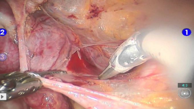 Robotic Surgery for Ovarian Cancer and Endometrial Cancer