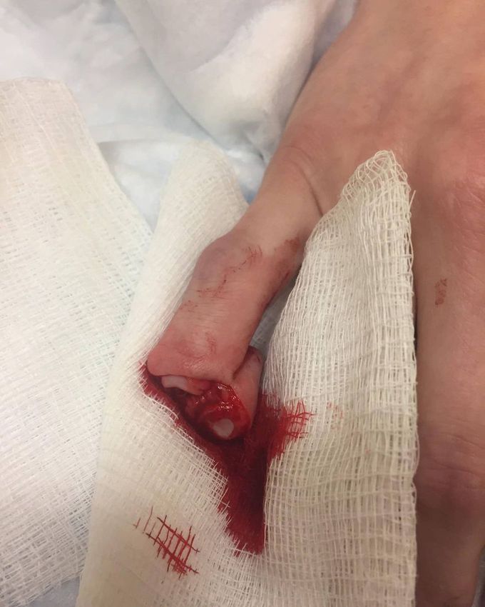Injury caused by a folding knife, slicing open the DIP joint of the fifth finger!
