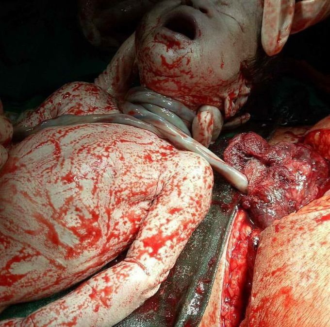 A case of cesarean section due to nuchal cord!
