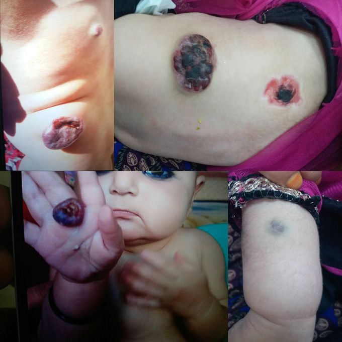 Hemangioma