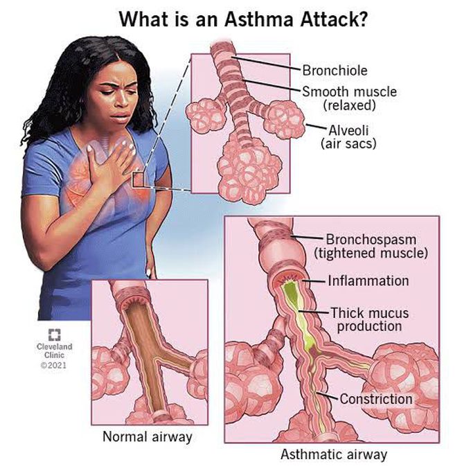 What happens in asthmatic attack?