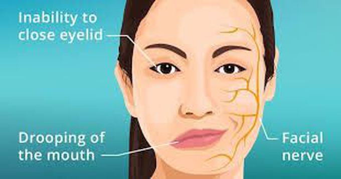 Symptoms of bell's palsy