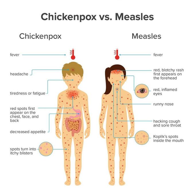 Chickenpox vs measles