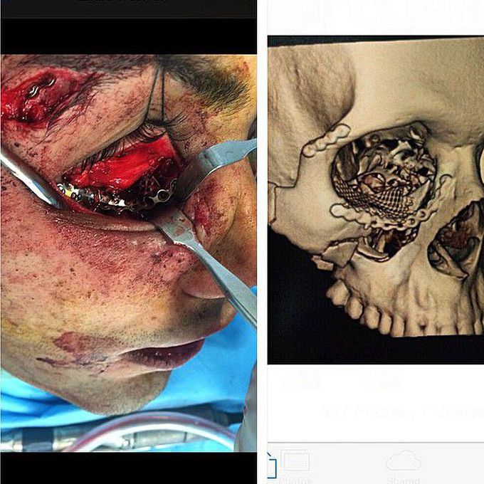 Orbital blowout fracture due to trauma - postoperative photo