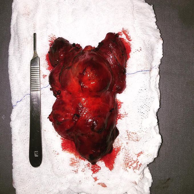 Multinodular thyroid gland removal
