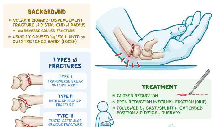 Smith fracture