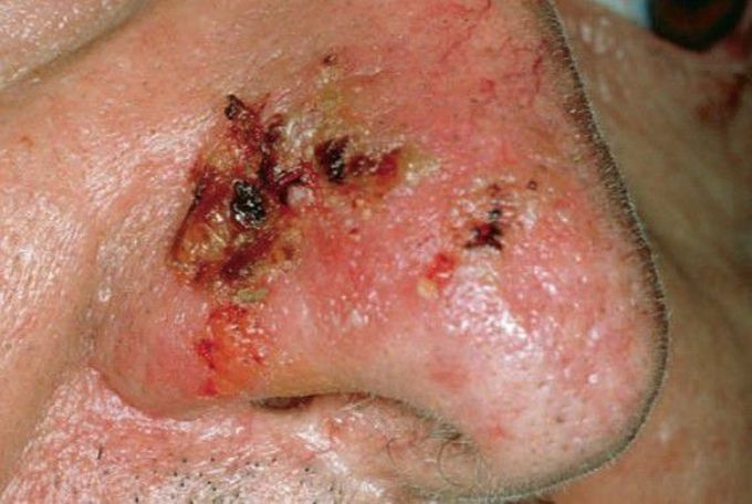 Cutaneous pemphigus vulgaris