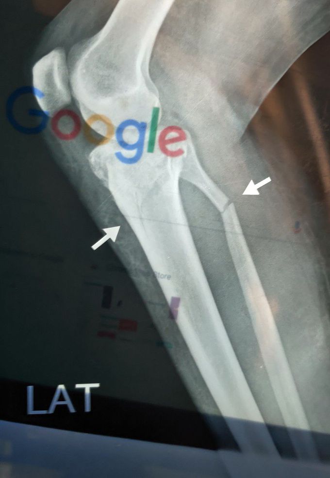 Tibia + Fibula Fracture