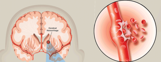 Hemorrhagic