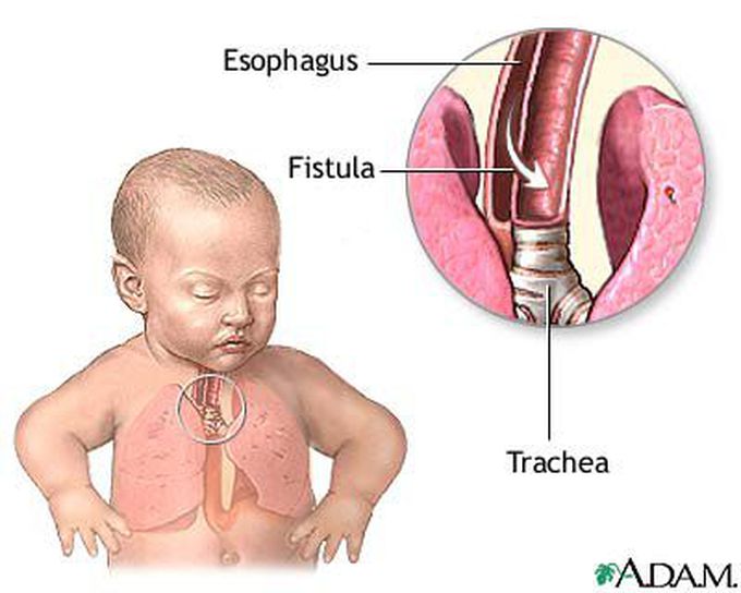 Tracheoesophageal Fistula