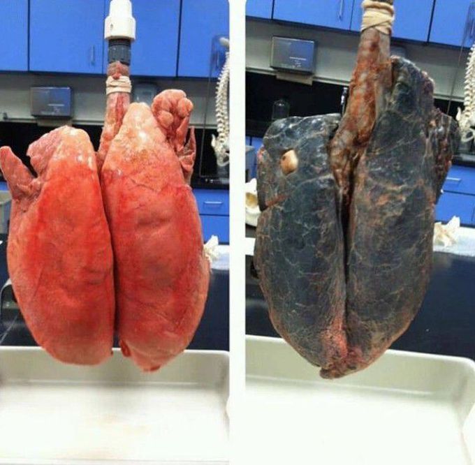 Healthy lungs vs Smoker's lungs