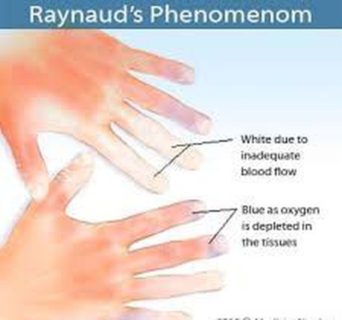 Raynaud's disease