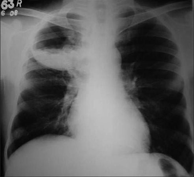 Lung Abscess