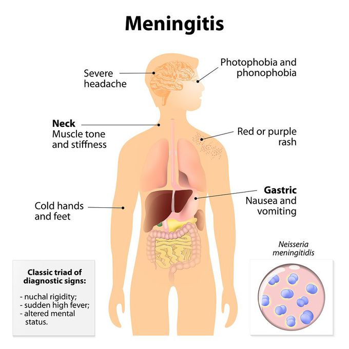 What are the symptoms of meningitis?