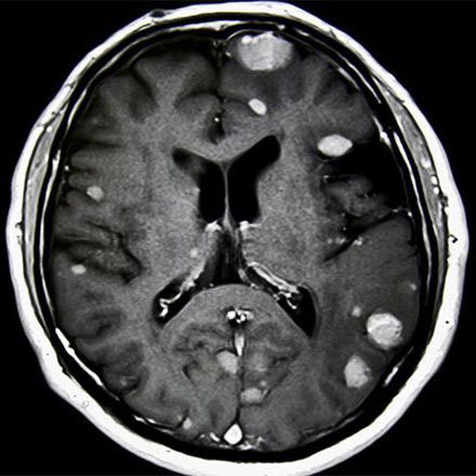 Metastatic brain Tumor/Cancer