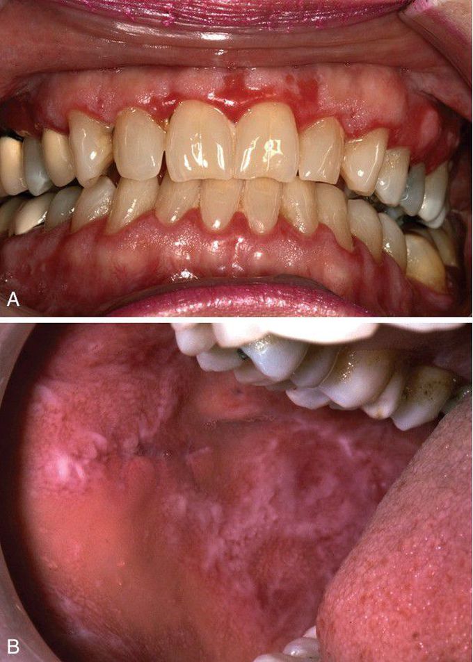 Chronic Ulcerative Stomatitis.