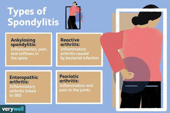 Spondylitis- Types
