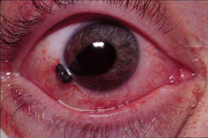 Blunt ocular trauma