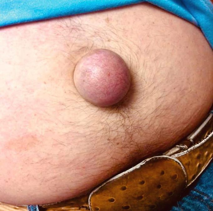 Umbilical hernia 