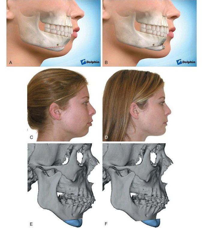 Inferior border modification (i.e., genioplasty) techniques