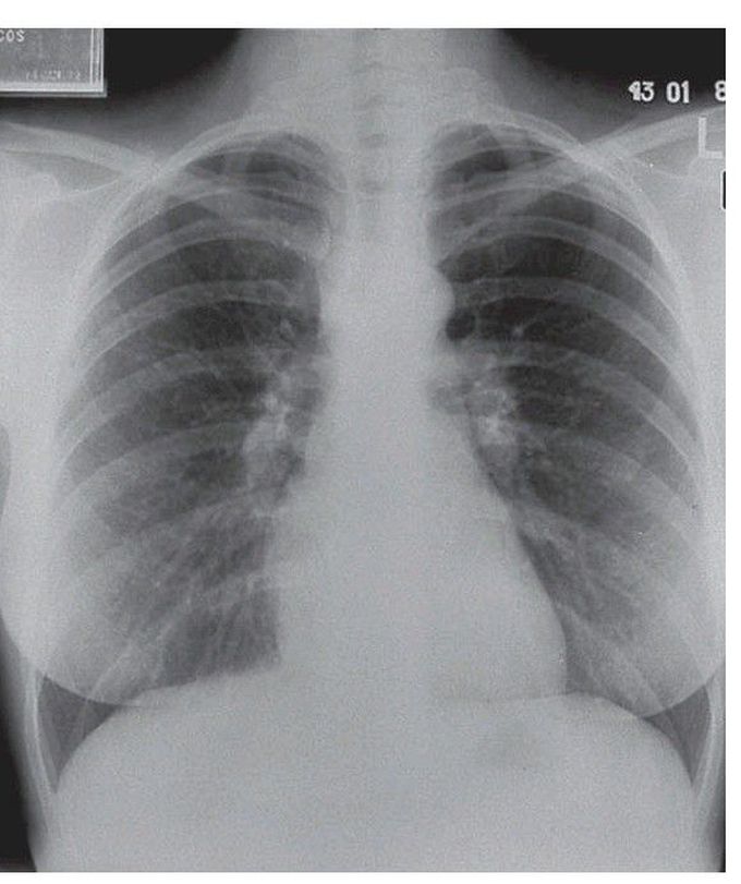 Sarcoidosis