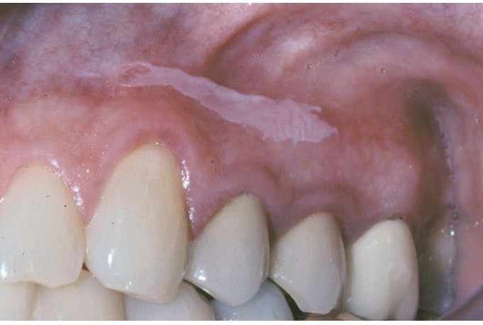 Sanguinaria-associated Keratosis