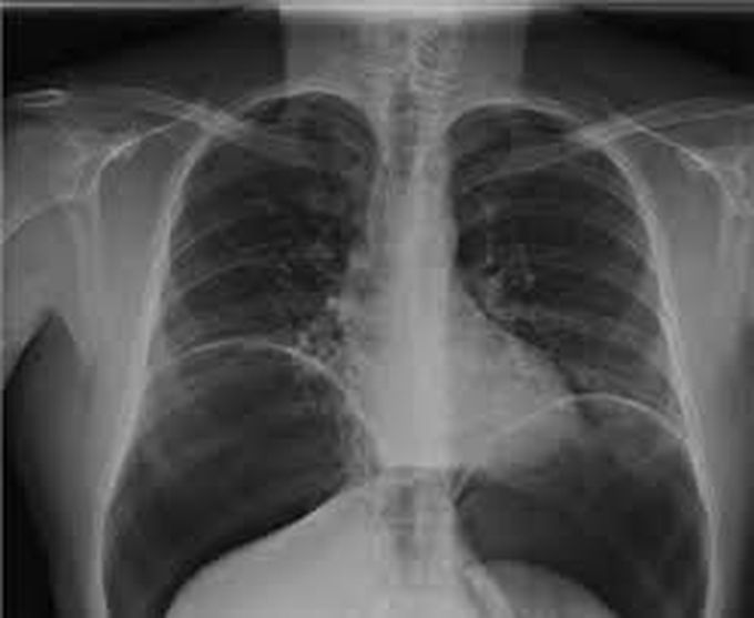 Pneumoperitoneum