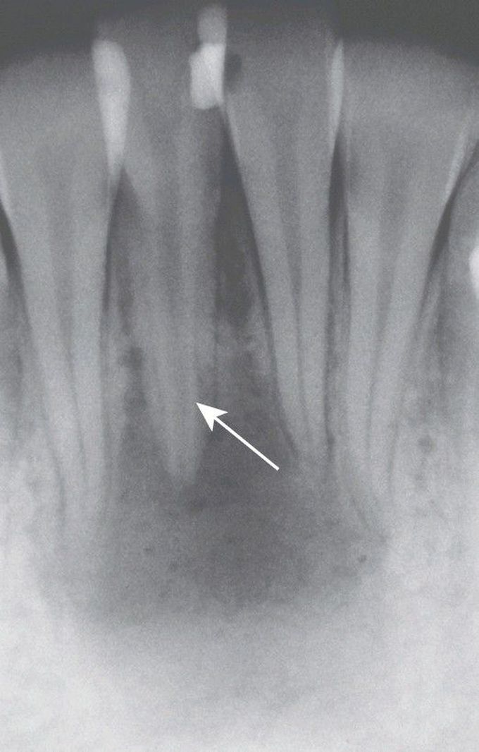 Physiologic Secondary Dentin.