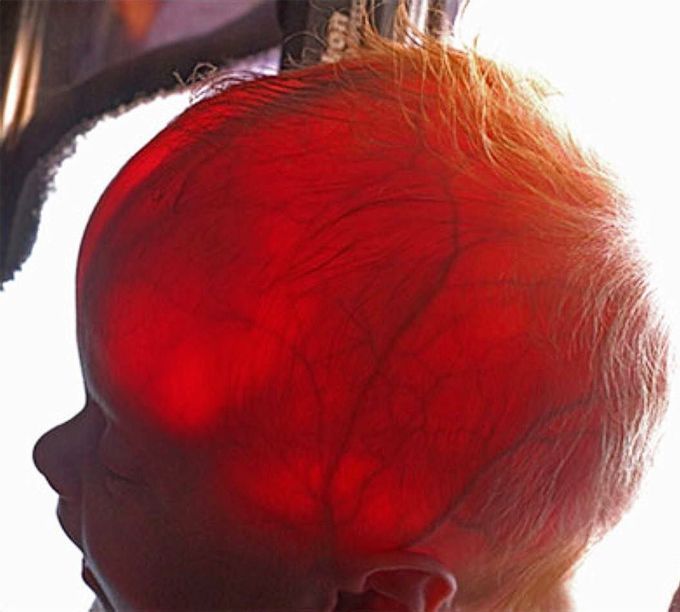 Transillumination of a newborn's head!