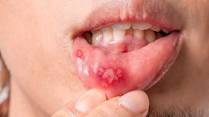 Canker Sores