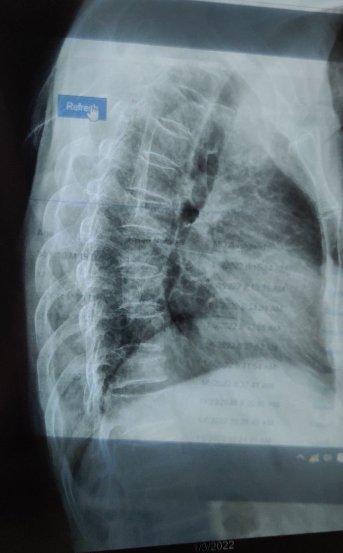 Kyphosis with osteoporosis