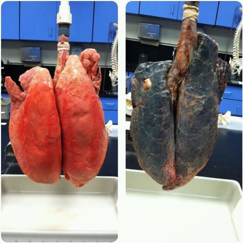 Lungs of a non smoker and a smoker!! - MEDizzy