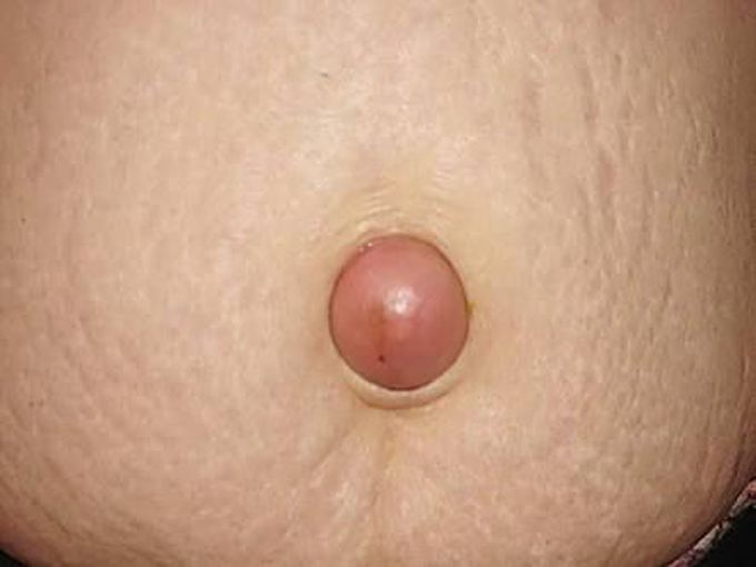 Umbilical Hernia