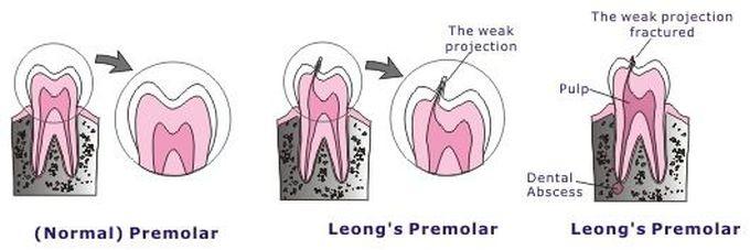 Leong's Premolar