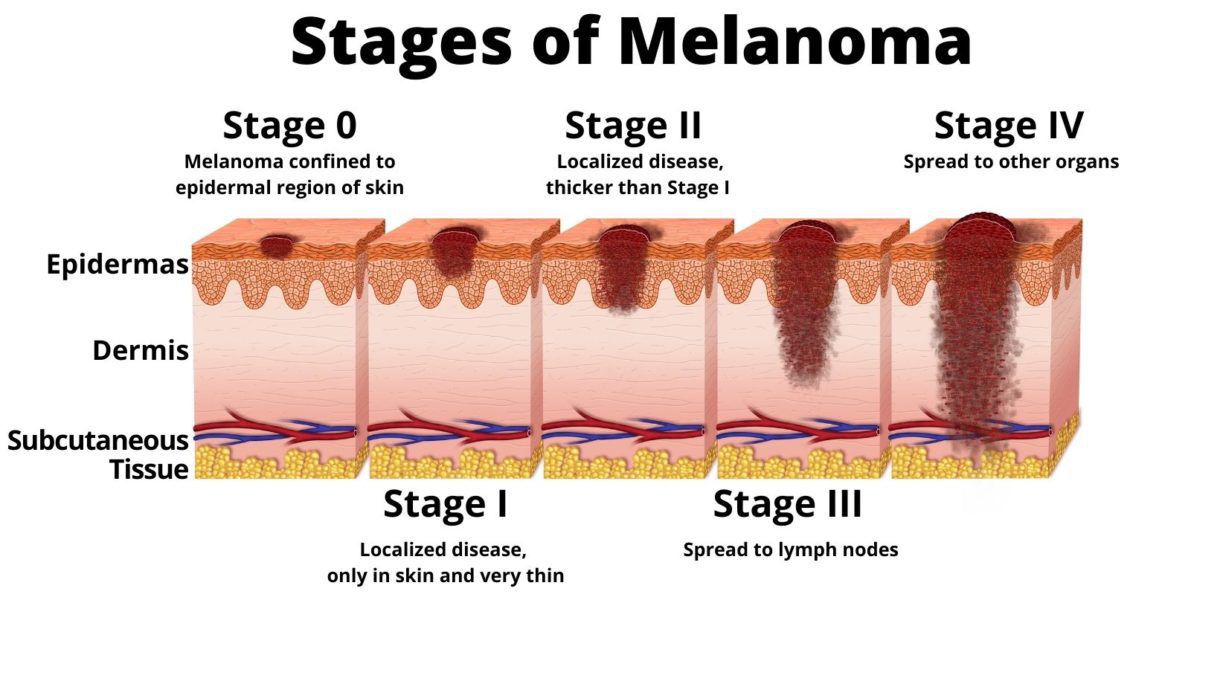 Stages of Melanoma - MEDizzy