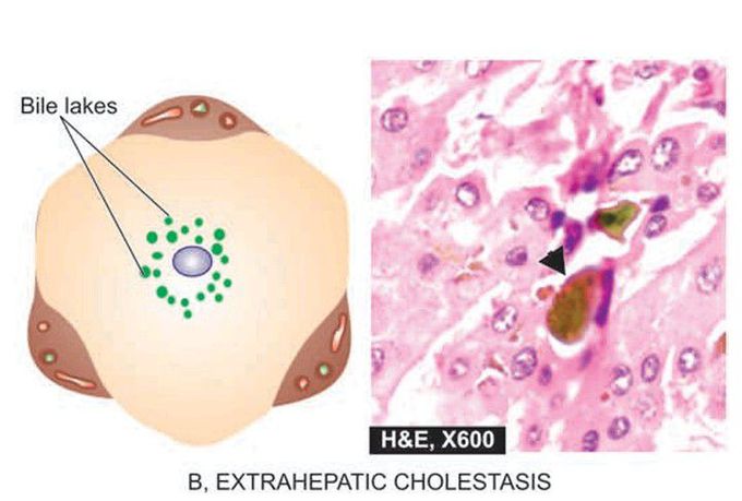 Salient features in morphology of liver in extrahepatic cholestasis.