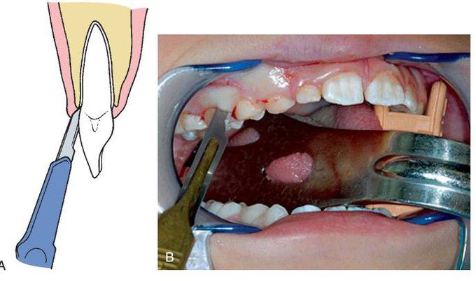 Principles of incision