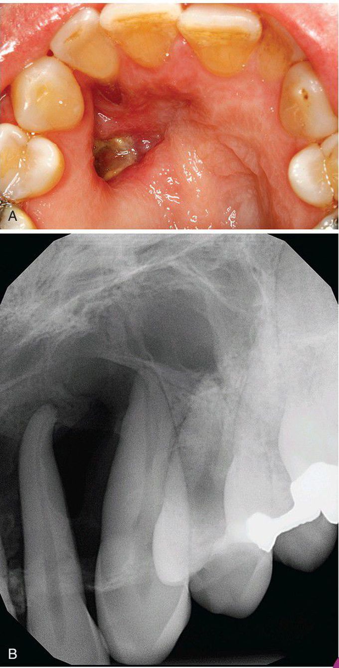 Odontogenic Fibroma