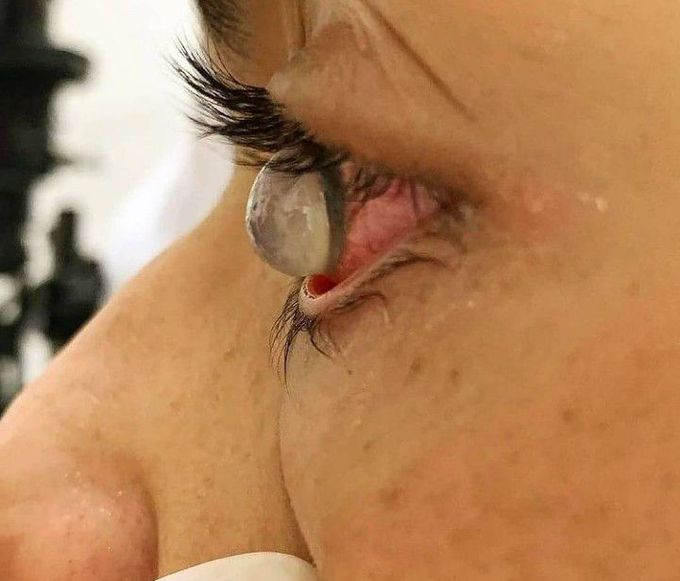 Corneal hydrops