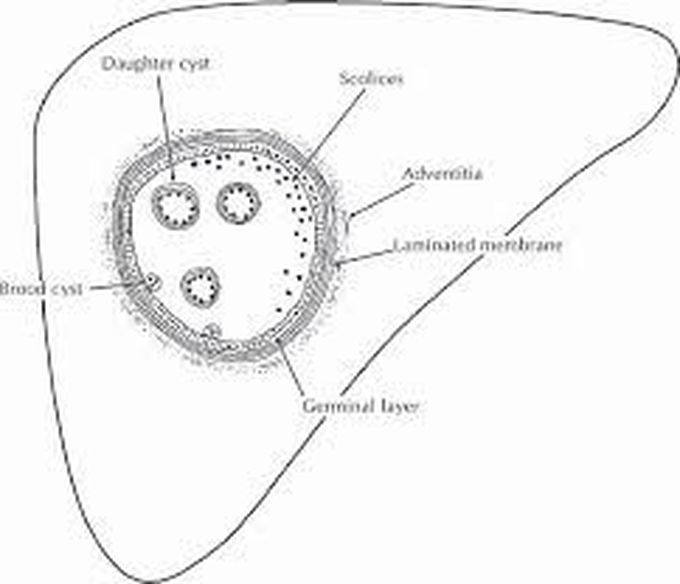 Hydatid cyst