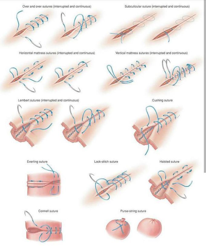 Different types of sutures